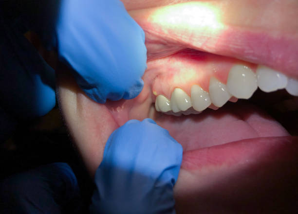 Best Emergency Wisdom Teeth Removal in Dunwoody, GA