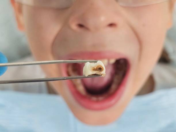 Best Emergency Treatment for Toothache in Dunwoody, GA
