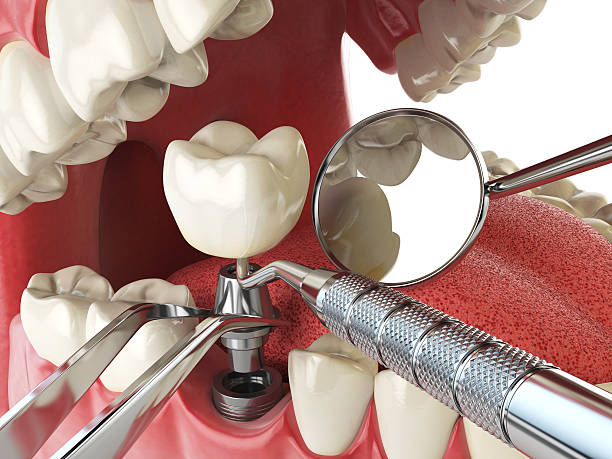 Best Emergency Broken Tooth Repair in Dunwoody, GA